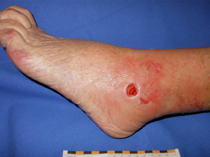 Dekubitus Grad 5 Bilder - Test 2