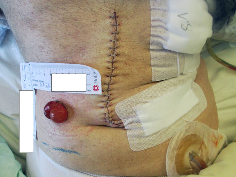 Stoma selbstständig versorgen