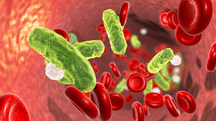 Fachgesellschaften fordern Nationalen Sepsisplan