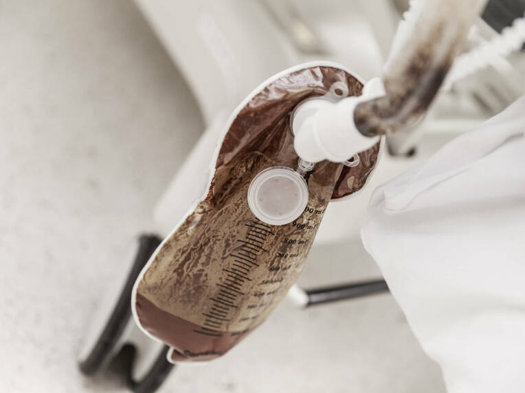 Bei häufiger Diarrhö können Stuhlableitungssysteme ein großer Vorteil sein – besonders auf Intensivstationen, wo viele Patienten betroffen sind.