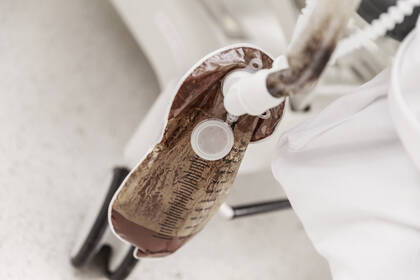 Bei häufiger Diarrhö können Stuhlableitungssysteme ein großer Vorteil sein – besonders auf Intensivstationen, wo viele Patienten betroffen sind.