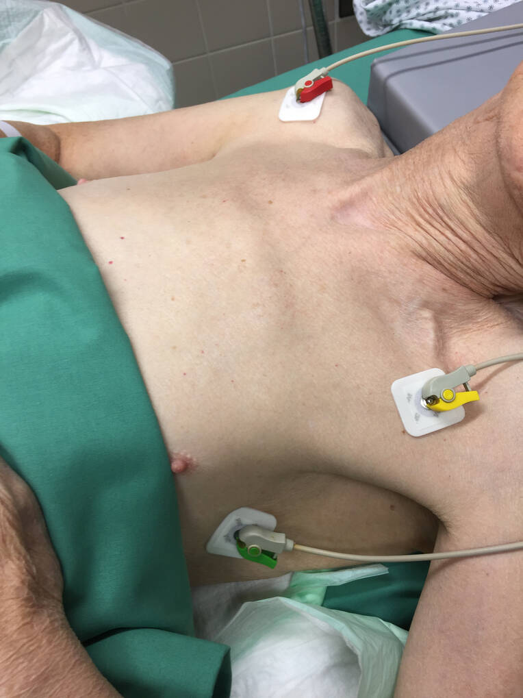 Herzrhythmusstörungen erkennen und beschreiben