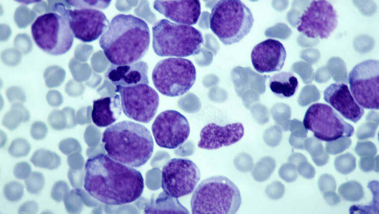 Bispezifische Antikörper revolutionieren die moderne Immuntherapie in der Onkologie. Erfahren Sie, wie sie neue Perspektiven eröffnen und welche Herausforderungen für Pflegefachpersonen entstehen.