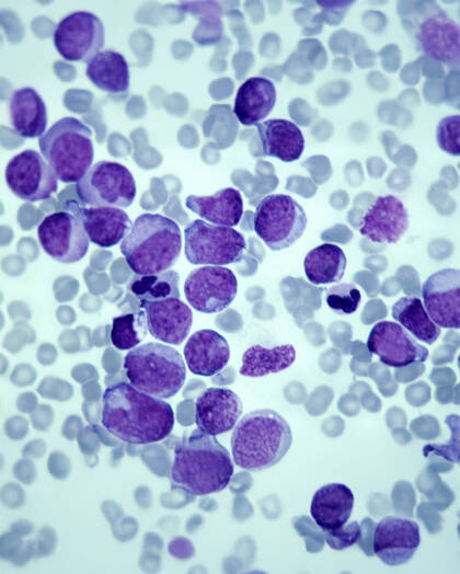 Bispezifische Antikörper revolutionieren die moderne Immuntherapie in der Onkologie. Erfahren Sie, wie sie neue Perspektiven eröffnen und welche Herausforderungen für Pflegefachpersonen entstehen.