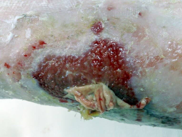 Ein Biofilm behindert die Wundheilung. Deshalb ist ein dreischrittiger Ansatz zur Bekämpfung, Entfernung und nachhaltigen Vorbeugung erforderlich.