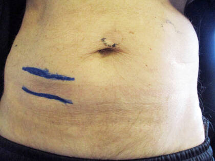 Im besten Fall sollte schon vor der OP die bestmögliche Position für das Stoma festgelegt werden. Dabei sind vielfältige Aspekte zu beachten.