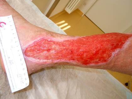 Evidenzbasierte Empfehlungen zur Diagnostik und Behandlung bietet die aktualisierte S2k-Leitlinie. 