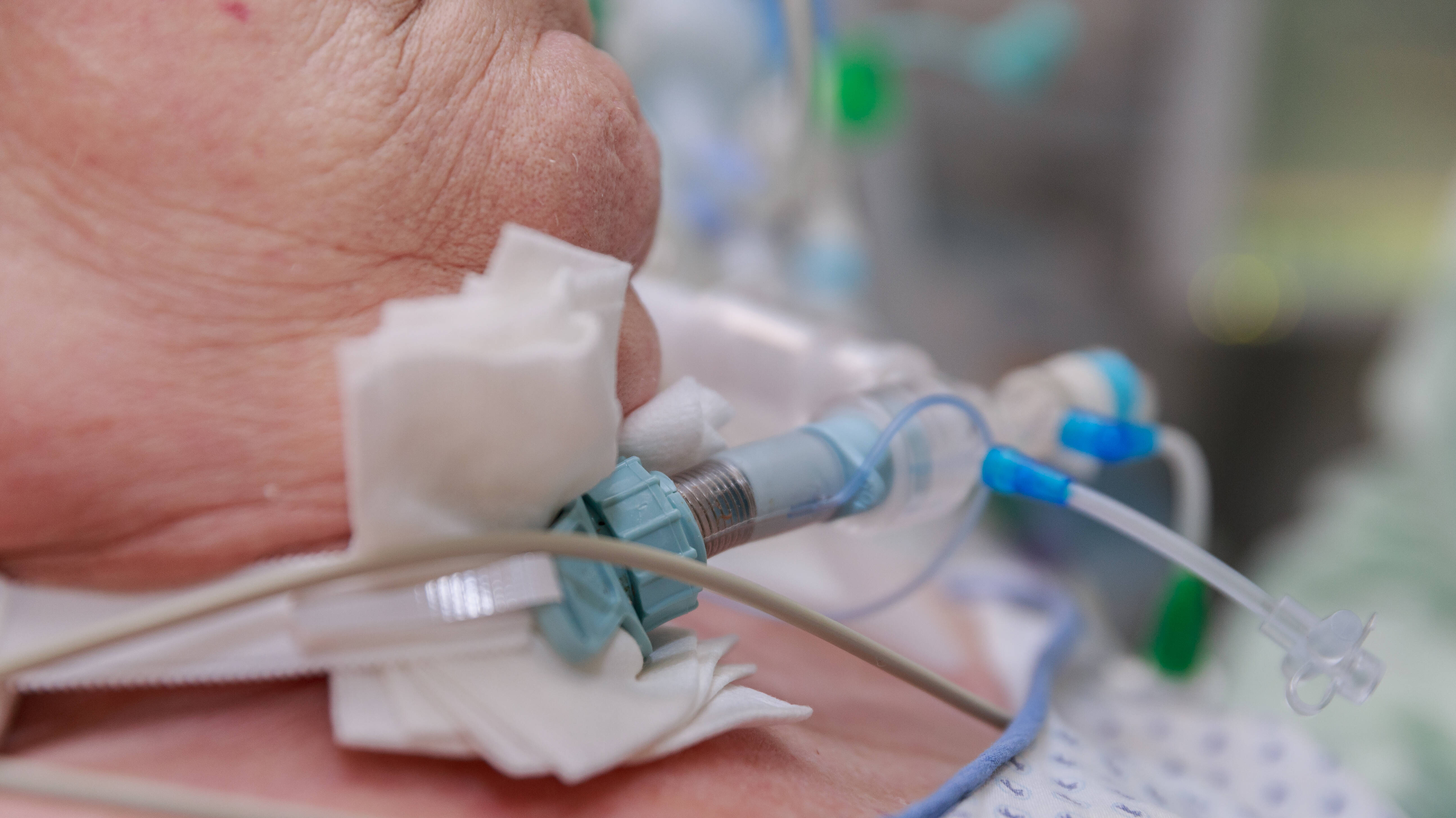 Intensivpatienten - Untersuchung zu Prdiktoren bei Weaningversagen