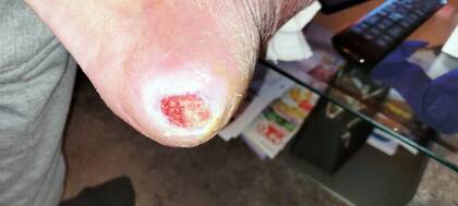 Dekubitus einheitlich klassifizieren