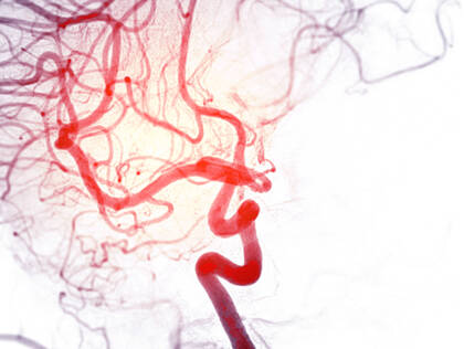 Frühmobilisation bei Subarachnoidalblutung