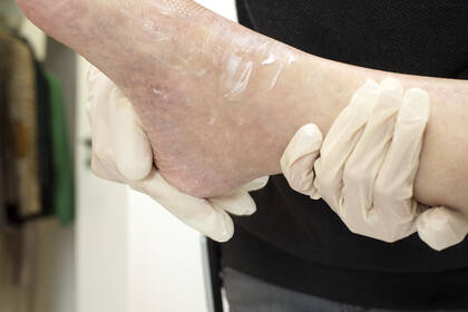 Über die Erkenntnisse der modellhaften Implementierung des Expertenstandards "Erhaltung und Förderung der Hautintegrität in der Pflege".