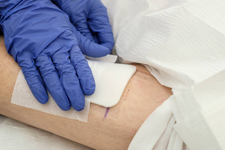 Eine neue antimikrobielle Wundauflage namens CISEB verbessert laut Studie die Heilung von Ulcus cruris venosum deutlich. Die Behandlung zeigt höhere Verschlussraten, kürzere Heilungsdauer und weniger Nebenwirkungen als die Standardtherapie mit DACC.
