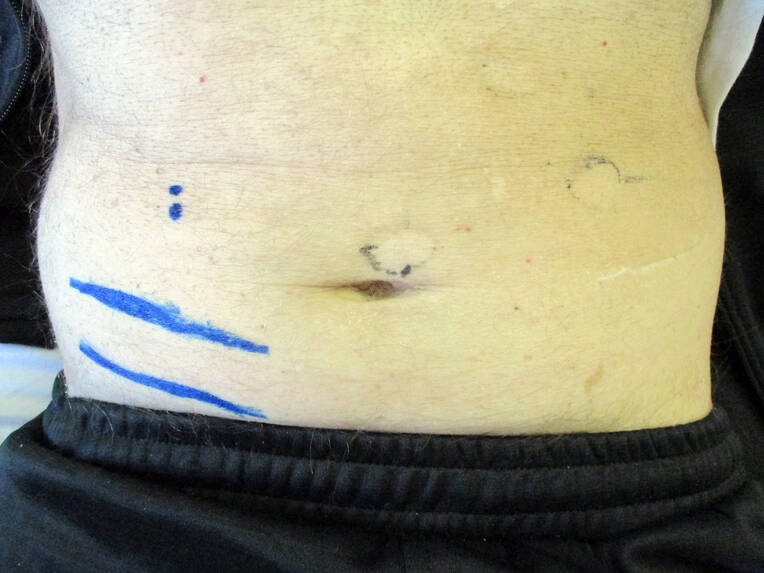 Stoma selbstständig versorgen