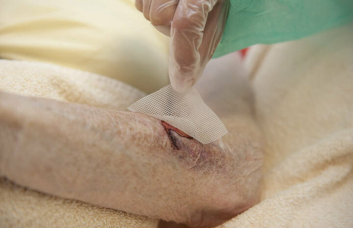 Der G-BA weist entsprechend qualifizierten Pflegefachpersonen in der häuslichen Wundversorgung eine entscheidende Rolle zu.