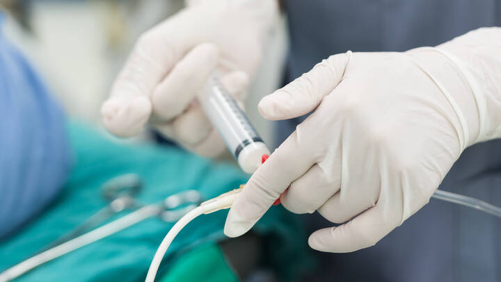 Anstelle von Inhalationsanästhetika nutzt die Anästhesiologie des Uniklinikums Erlangen für Vollnarkosen standardmäßig das intravenöse Propofol. 