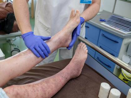 Kann Kompression einer Thrombose vorbeugen?