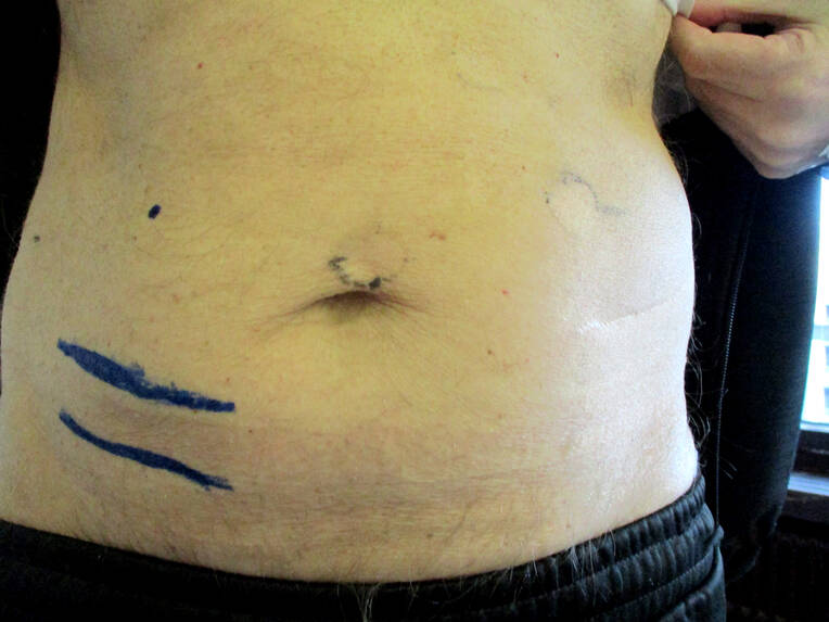 Stoma selbstständig versorgen
