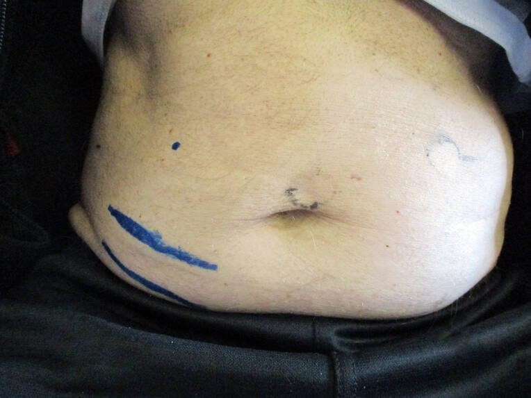 Stoma selbstständig versorgen