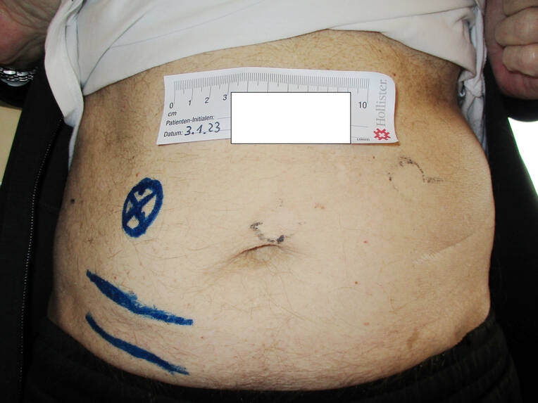 Stoma selbstständig versorgen