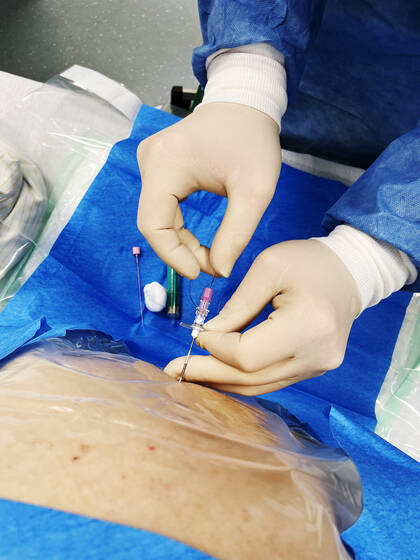 Thorakale Epiduralanästhesie: Goldstandard im Fast-Track-Konzept