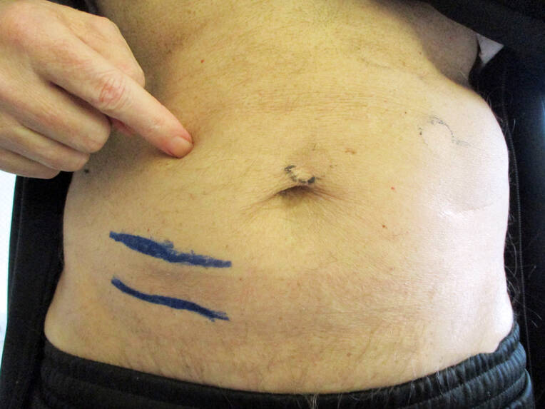 Stoma selbstständig versorgen